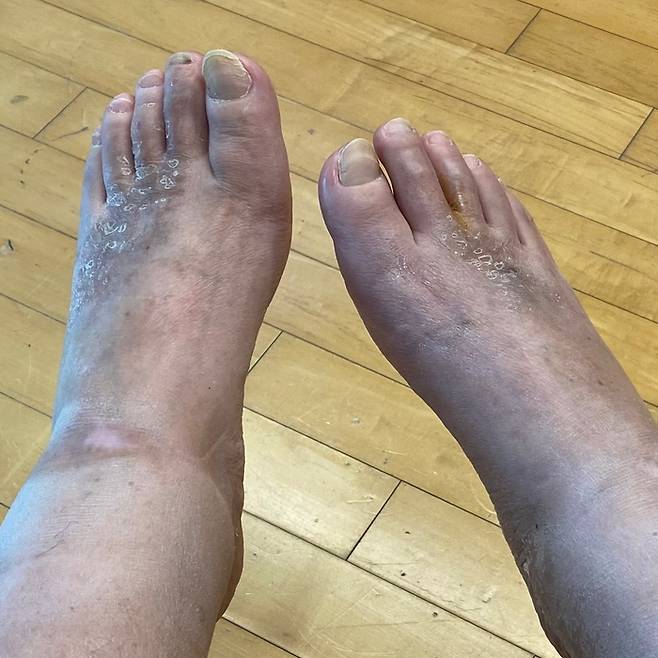 강원래의 발 상태. 김송 SNS.