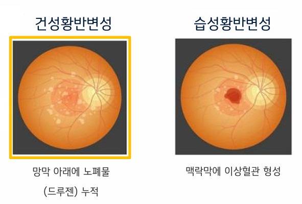 건성 황반변성은 전체 황반변성 중 85~90%를 차지한다.(제공= 와이투솔루션)