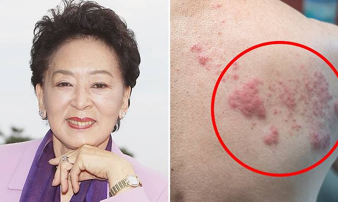 故 배우 김지미(왼쪽), 대상포진 환자 몸에 생긴 붉은 반점과 물집 모습. 연합뉴스·게티이미지뱅크