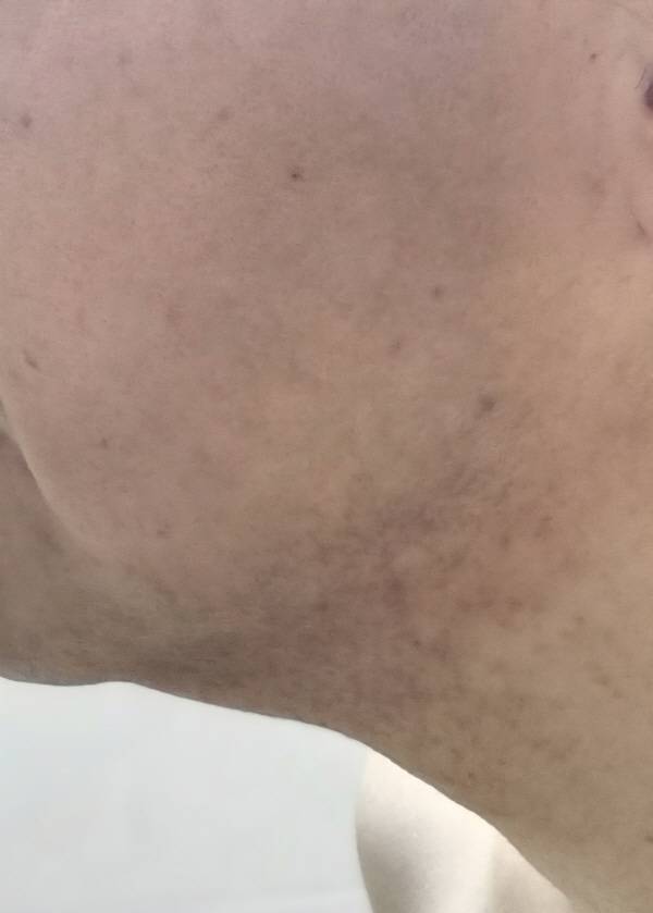 브라운 면도기 시리즈 9 PRO+ 울트라씬을 이용해 아침에 습식 면도 후 모습(오른쪽 목과 턱선). 정옥재 기자