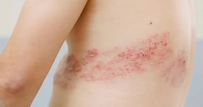대상포진은 띠 모양의 발진과 함께 해당 부위의 극심한 신경통이 나타나는 증상을 보인다. 게티이미지