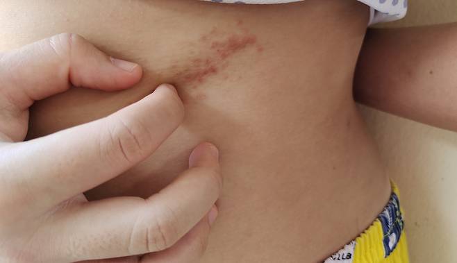 피부 염증 등에 사용하는 스테로이드 약도 의사, 약사와 상담한 후 신중하게 투여해야 부작용을 막을 수 있다. 사진=게티이미지뱅크