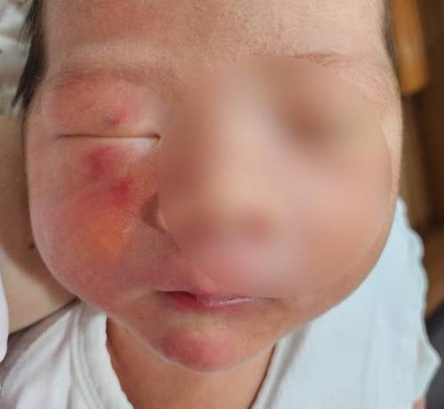 생후 4일 된 영아 얼굴에 난 상처 [독자 제공. 연합뉴스]