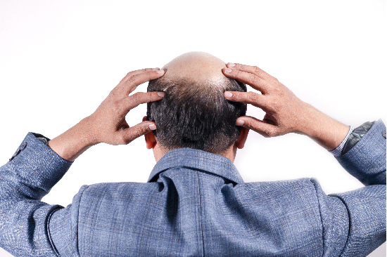탈모. (사진=게티이미지뱅크)