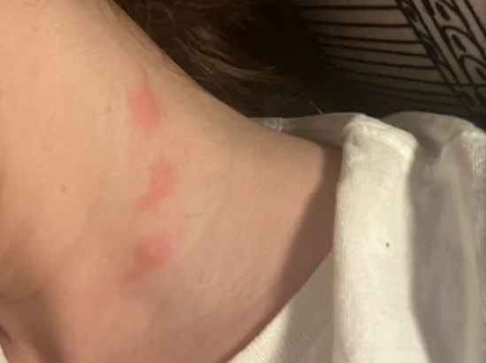 빈대에 물린 자국.[레딧(Reddit) 갈무리]