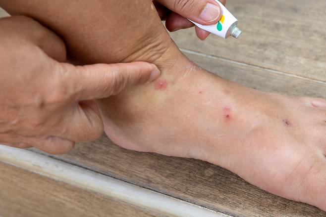 빈대에 물린 자국.[게티이미지뱅크]