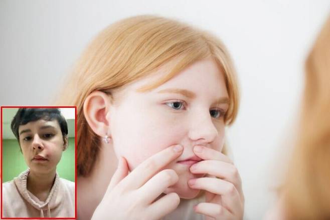 얼굴에 난 작은 여드름을 무심코 짰다가 한쪽 얼굴이 마비되는 증상을 경험한 여성의 사연이 소개됐다. 사진=게티이미지뱅크