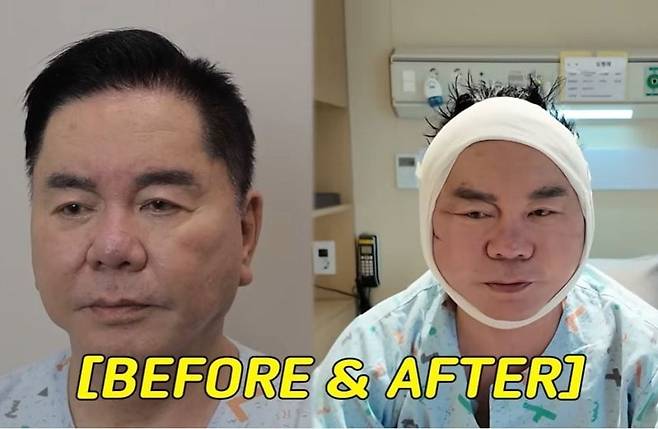 개그맨 심형래가 안면 거상 수술을 받기 전과 후의 모습. /유튜브 '영구TV'