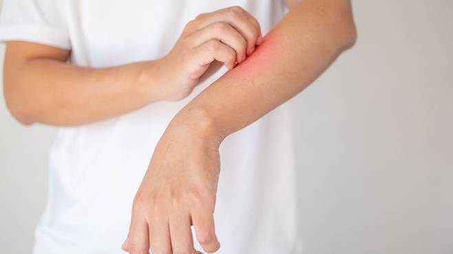 건선은 각질, 붉은 발진을 동반하는 만성 염증성 피부질환이다 | 출처: 게티이미지뱅크