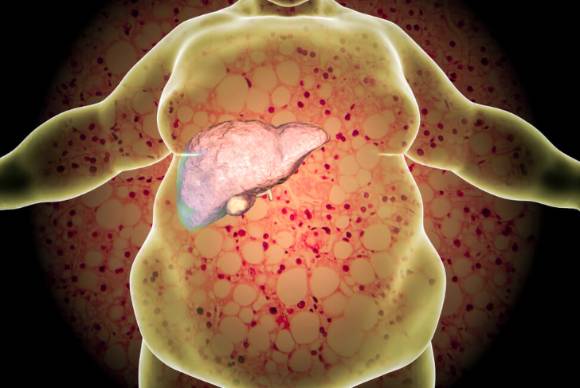 지방간 관리에 도움이 되는 음식이 전문가에 의해 공개됐다. 사진은 본 기사 내용과 무관. [사진=Rocky Mountain Gastroenterology]