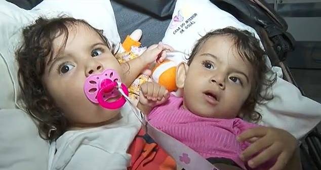 브라질 샴쌍둥이(결합쌍둥이) 자매의 수술 전 모습. /사진=데일리메일