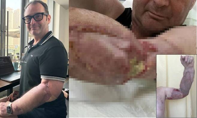 평소 운동을 즐기며 건강에 자신 있던 한 50대 남성이 단순한 인후통 겪은 후 치사율 20%에 달하는 세균에 감염돼 팔을 거의 절단해야 한 순간까지 간 사연을 공유했다. 괴사성 근막염 이후 팔에 근육과 지방을 이식해 재건한 모습. 사진=SNS