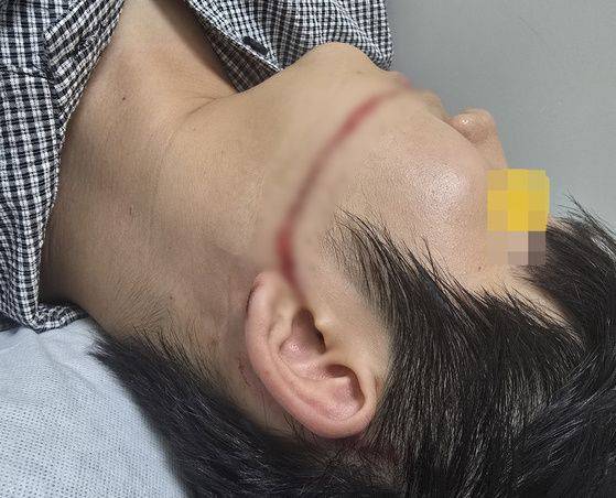 물축제 공연중 워터건에 맞아 얼굴을 크게 다친 피해자. 연합뉴스