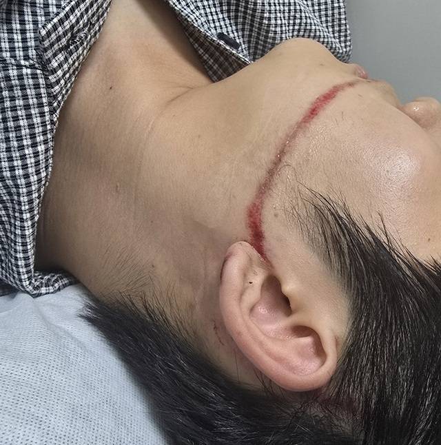 A performer’s face is left visibly injured after being struck by a water gun during a performance at the Ansan Summer Festa 2025 Water Festival Yeoreumio on Aug. 15 last year. The performer said he is still receiving treatment for scars. (Yonhap)