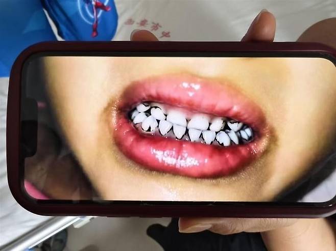 중국 서북부 간쑤성의 한 유치원에서 발생한 집단 납중독 사건으로 치아 일부가 검게 변한 유치원생. [중국 매체 지무뉴스 캡처]