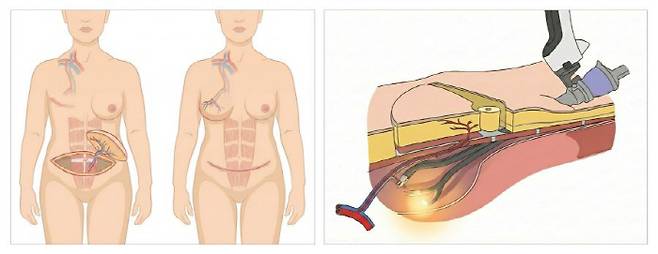 다빈치 로봇을 활용한 심하복벽 동맥 천공지 피판술(DIEP)의 개념도.