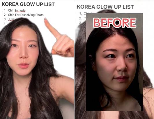 A TikToker introduced a “Korea Glow Up List,” recommending beauty treatments — including chin InMode — for a glow-up in Korea. [SCREEN CAPTURE]