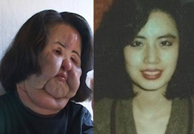 '선풍기 아줌마' 고 한혜경씨는 불법 성형으로 예전의 미모(오른쪽)를 잃고 고통받았다. 사진=SBS '꼬꼬무'