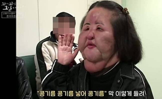 한씨는 자신의 얼굴에 파라핀오일, 공업용실리콘, 콩기름을 주사했다가 부작용에 시달렸으며, 환각 환청도 겪었다. 사진=SBS '꼬꼬무'