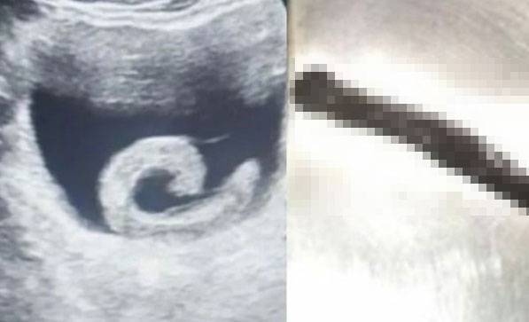 중국의 한 20대 남성이 온라인에서 본 민간요법을 따라 요도에 거머리를 삽입했다가 극심한 통증으로 응급실을 찾는 사건이 발생했다./사진=웨이보 캡처