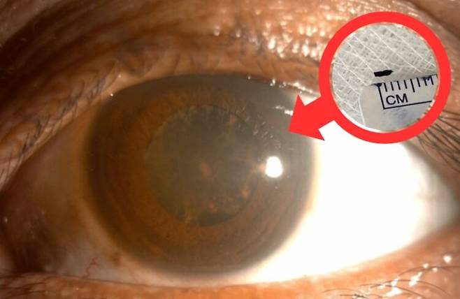 시력 이상을 겪던 40대 남성 눈에서 철 조각(동그라미 안)이 발견됐다. 사진=큐레우스 저널