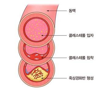 고지혈증 [서울아산병원 제공]