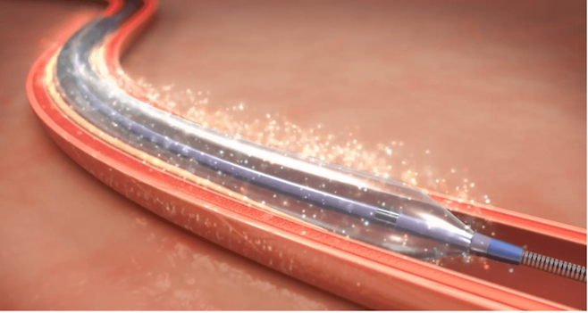 풍선 카테터가 확장되며 약물이 스며드는 장면