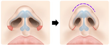 또한 콧볼 축소는 코끝과 콧볼의 비율을 무너뜨려 코끝이 더 커보이는 역설을 낳기도 합니다. 사진=슈어스성형외과