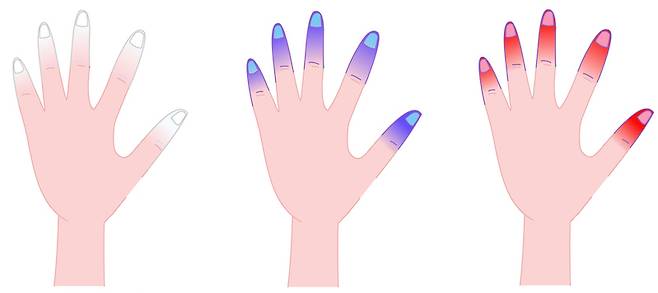 레이노병에 걸린 손가락의 3단계 색깔 변화. /사진=게티이미지뱅크