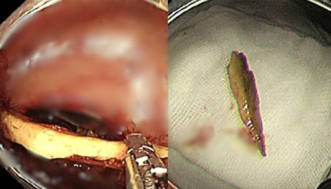 50대 여성 직장에 박혀 있었던 3.3cm 크기의 오리뼈. 사진=clinical case reports