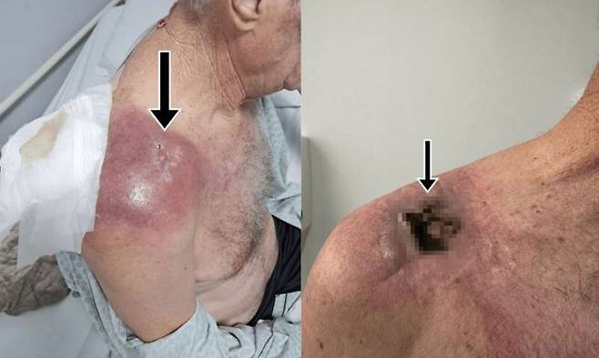 오존 치료 후 화농성 관절염이 발생한 65세 남성의 사연이 공개됐다/사진=큐레우스