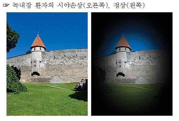 中 연구팀은 “경정맥 압박을 유발하지 않는 수면 자세가 녹내장 환자의 안압 상승 완화에 도움이 될 수 있다”고 설명했다. 사진은 녹내장 환자의 시야손상을 나타낸다. 서울대병원