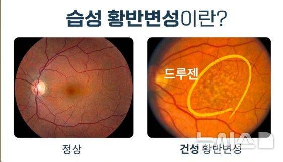 [서울=뉴시스] 황반변성 이미지. (사진= 분당서울대병원 제공)