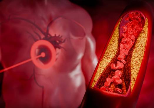 고지혈증 관리에 도움이 되는 음식과 섭취 방법이 전문의를 통해 나왔다. 사진은 본 기사 내용과 무관. [사진=intercoastalmedical]