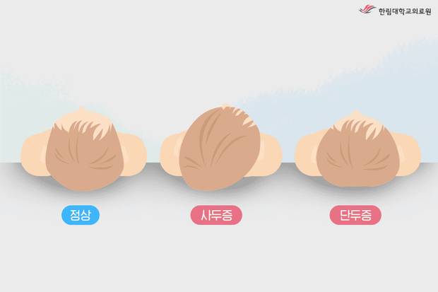 자세형 사두증의 유형. 사진 제공=한림대 동탄성심병원