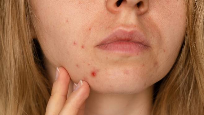 성인 여드름의 원인은 호르몬 불균형, 스트레스, 생활습관 등 복합적이다｜출처: 클립아트코리아