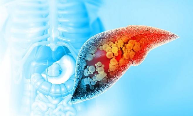 소리 없이 다가와 생명을 위협하는 간암, 예방을 위해서는 정기적인 검진만이 정답이다. 게티이미지뱅크
