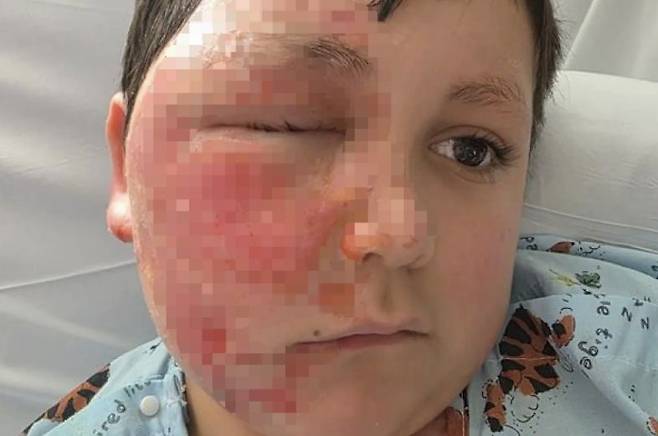 9세 소년이 심각한 화상을 입었다. 출처=시카고 선 타임즈