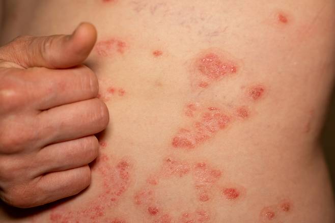 급격한 알레르기 반응을 일컫는 아나필락시스성 쇼크는 심할 경우 사망에 이르기까지 한다. 음식 섭취, 백신 접종 조영제 투여 등에 의해 발생할 수도 있다. 해당 사진은 기사 본문과 관계없습니다. [123RF]