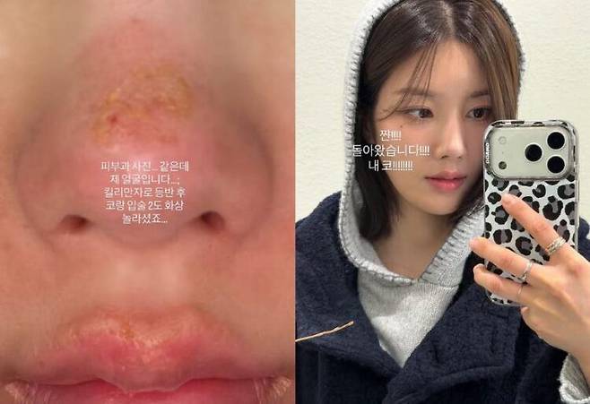 가수 권은비(31)가 킬리만자로를 등반한 후 코와 입술에 2도 화상을 입었다고 밝혔다. 사진=권은비 SNS, 뉴시스