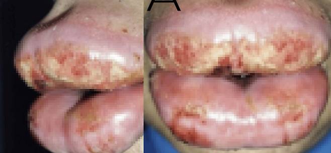 입술 필러 시술 후 심한 수포와 딱지, 통증 등 부작용이 발생한 사례가 보고됐다./사진=큐레우스
