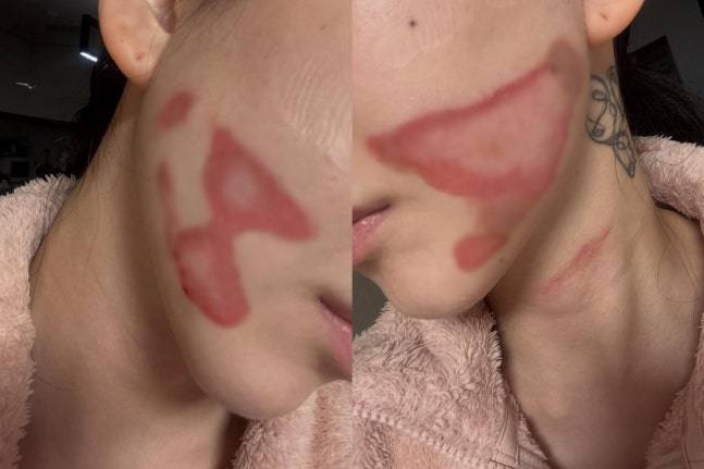 걸그룹 AOA 출신 배우 권민아가 피부과 시술을 받다 얼굴에 화상을 입었다고 밝혔다. /사진=권민아 인스타그램