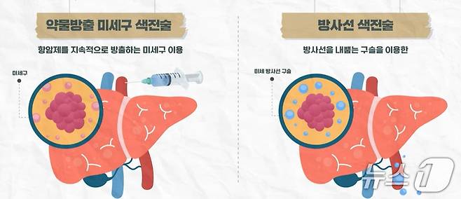 최신 간암 색전술.(서울대병원 제공)