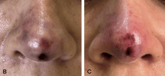 한 여성이 코에 필러 주사를 맞은 후 심각한 부작용을 겪은 사례가 보고됐다. /사진=큐레우스