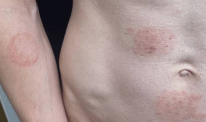 곰팡이균의 일종인 ‘트리코피톤 멘타그로피테스 7형’(TMVII)가 성관계를 통해 전파되는 것으로 확인됐다. 미국 질병통제예방센터(CDC)