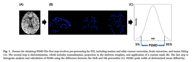 그림 1. PSMD 산출 과정 뇌 확산텐서영상(DTI)에서 주요 백질 신경섬유만 추출한 뒤, 확산도 분포의 상위 95%와 하위 5% 값의 차이를 계산해 PSMD를 산출한다. PSMD 값이 클수록 뇌 백질의 미세구조 손상이 큰 것으로 해석된다. 사진=해운대백병원