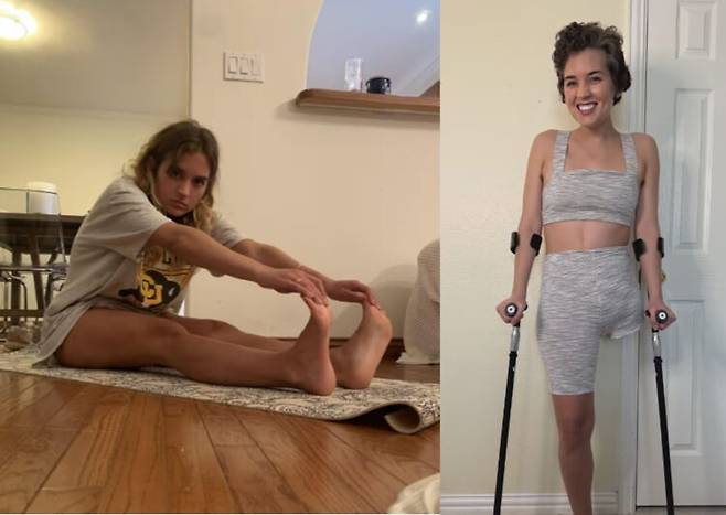 다리 통증으로 병원을 찾았다가 결국 골반 일부까지 절단하는 수술을 받게 된 30대 여성의 사연이 전해졌다. 수술 전과 후 모습. 사진=SNS