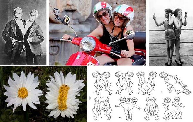 왼쪽 위에서부터 시계방향으로 창과 엥(위키피디아), 어비가일과 브리트니(BBC), 데이지와 바이오렛(Everett Collection), 여러 형태의 결합쌍둥이(ResearchGate), 식물에서의 기형 생장(위키피디아). 사진=유영현 제공