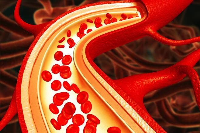 고지혈증은 의학적으로 ‘이상지질혈증’이라 불리며, 혈액 속 지방 성분의 균형이 깨진 상태를 의미한다. 게티이미지뱅크