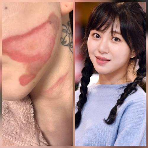 그룹 AOA 출신 배우 권민아가 피부 시술 화상 피해를 공개한 가운데, 그보다 더 깊은 상처를 드러냈다. 사진=SNS, DB